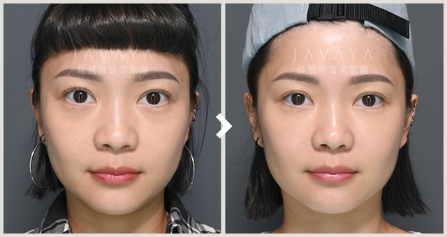 玻尿酸_M字唇精雕_09